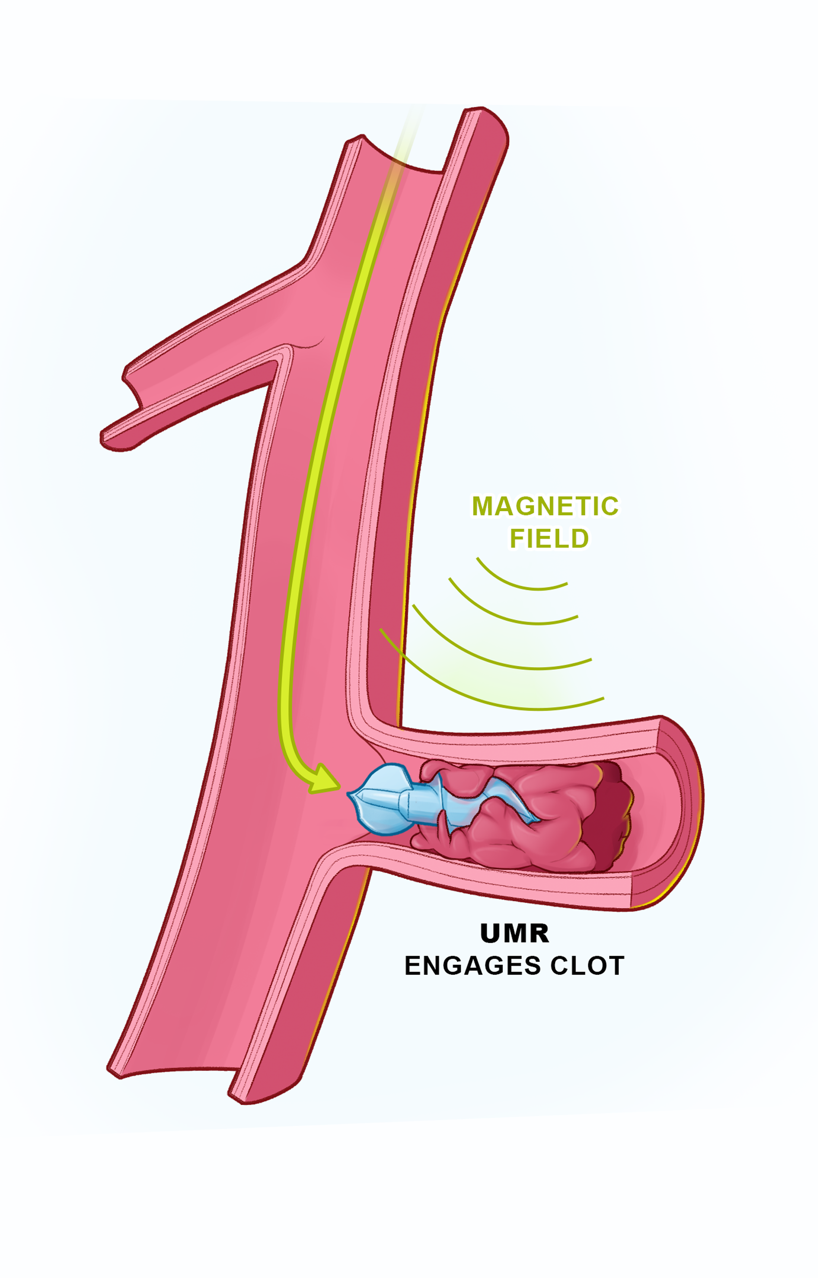 Clot device TURBO_case.png