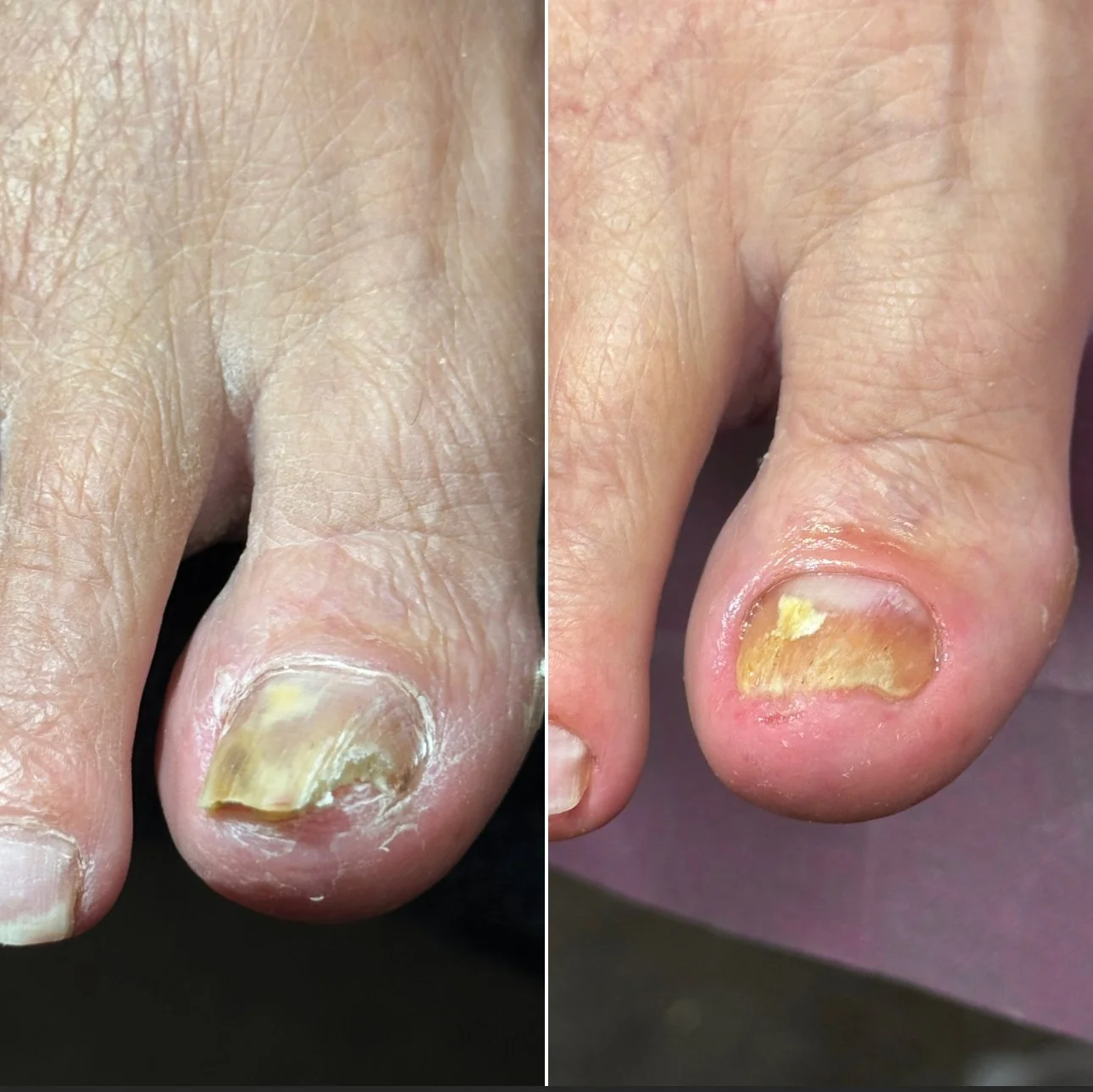 Toenail Debridement 