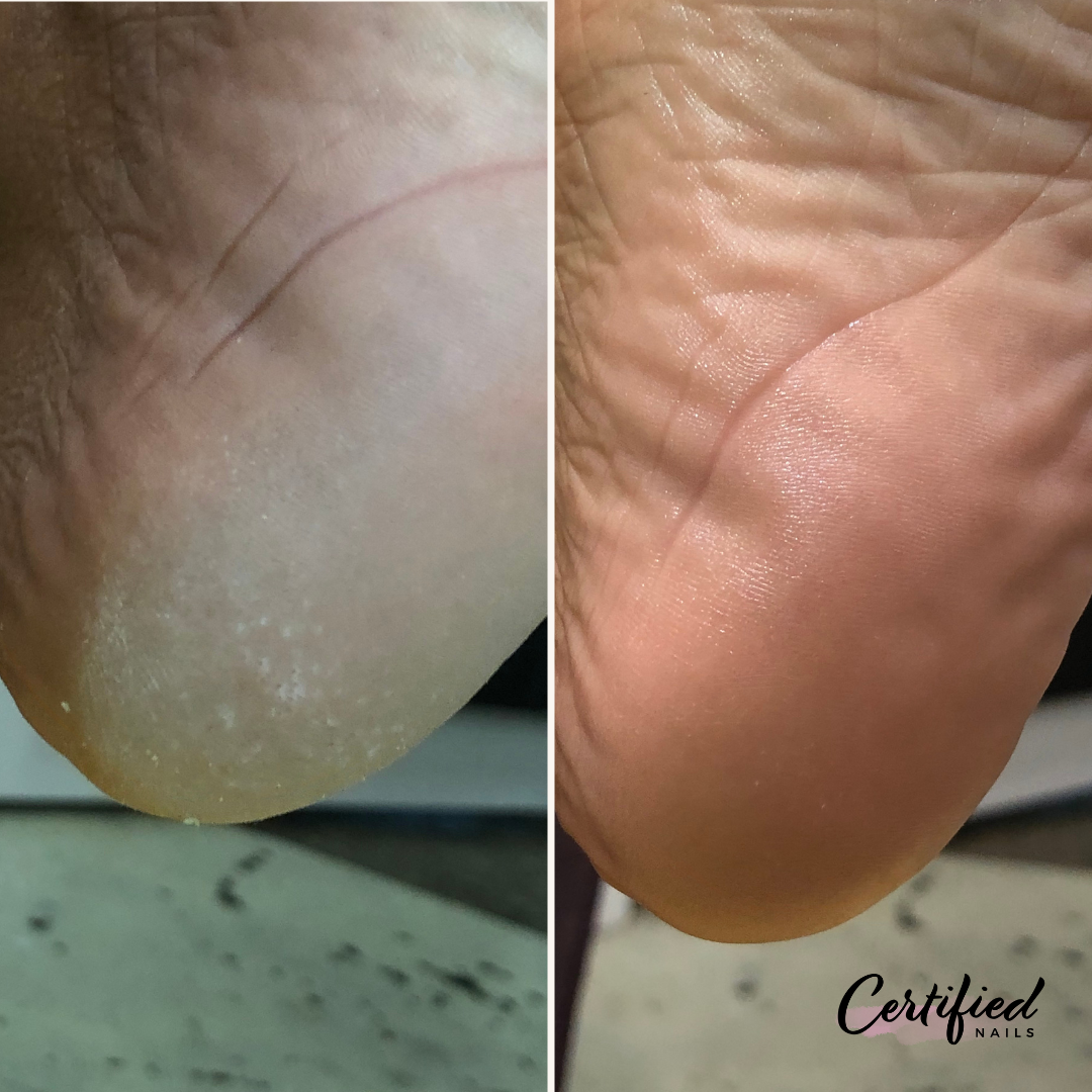 Medial Pedicure