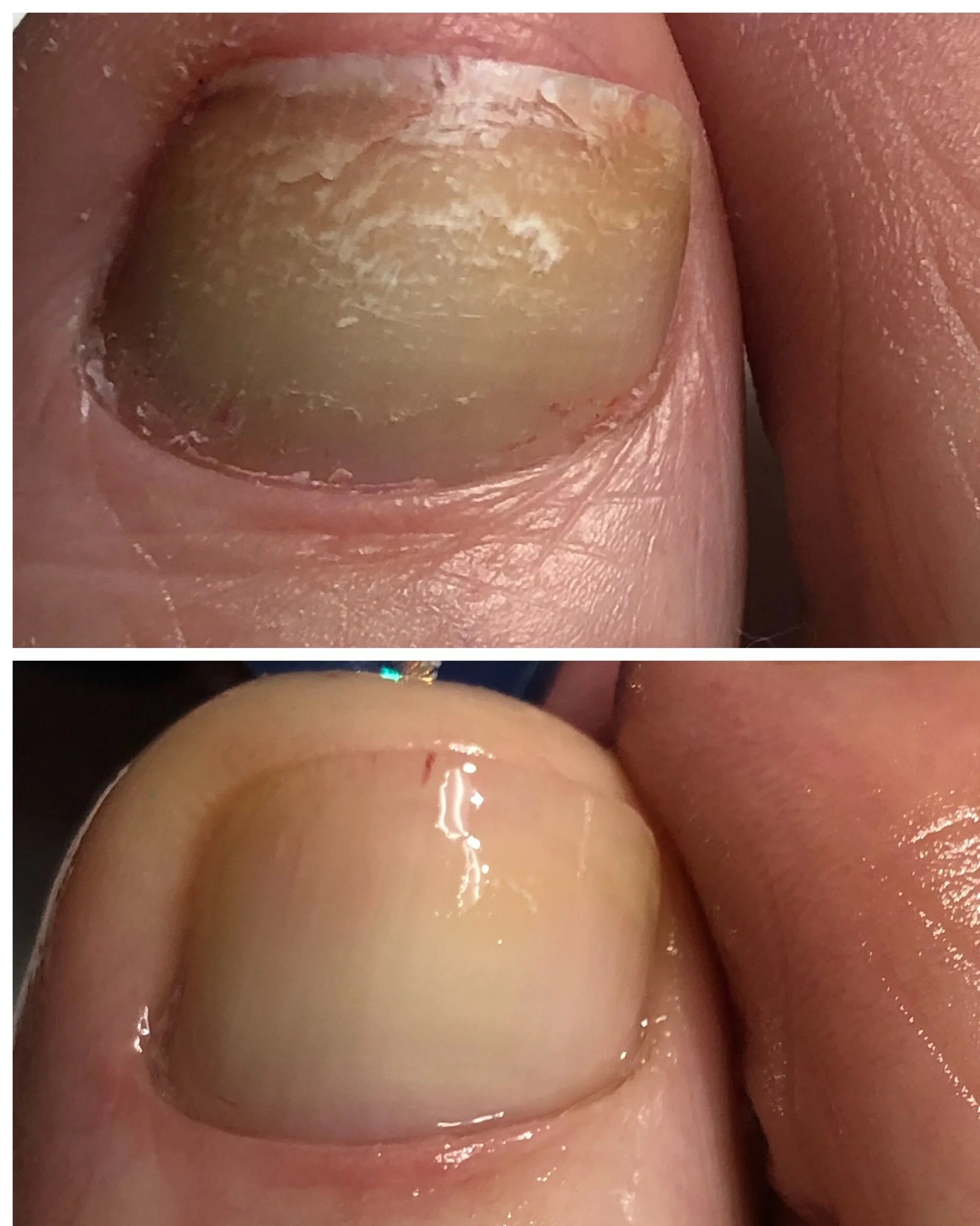 Close-up photographs of a fingernail showing signs of nail damage, with one image depicting a dry, peeling, discolored nail and the other showing a healthier, smoother nail.