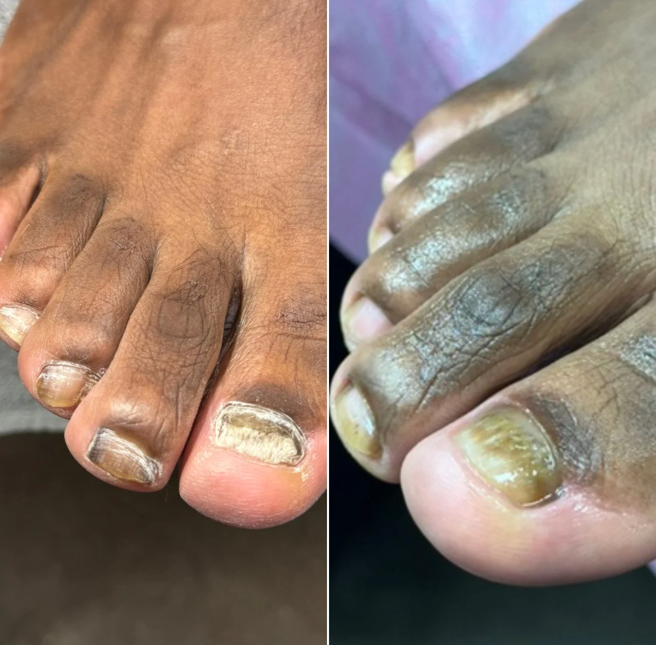 Toe Nail Debridement 