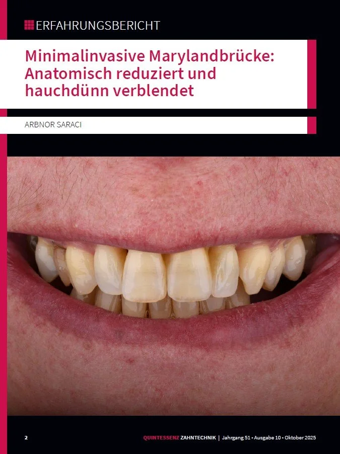 Quintessenz Zahntechnik 10/2025 - Minimalinvasive Merylandbrücke