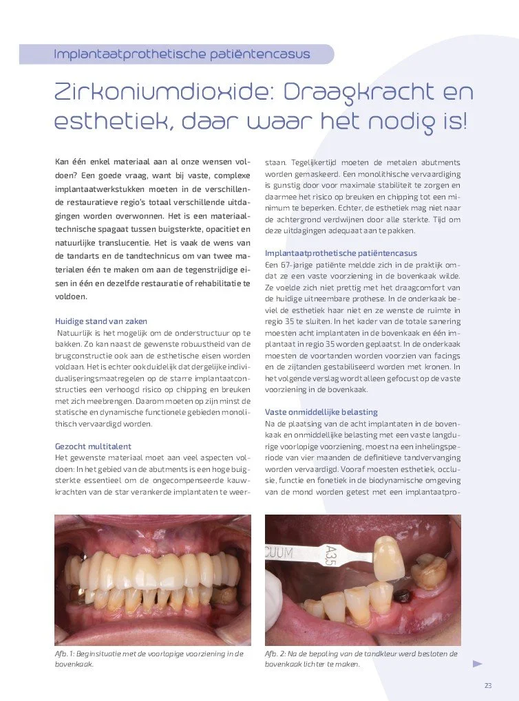 SDU NL - 01/2025 - Zirkoniumdioxide: Draagkracht en esthetiek, daar waar het nodig is