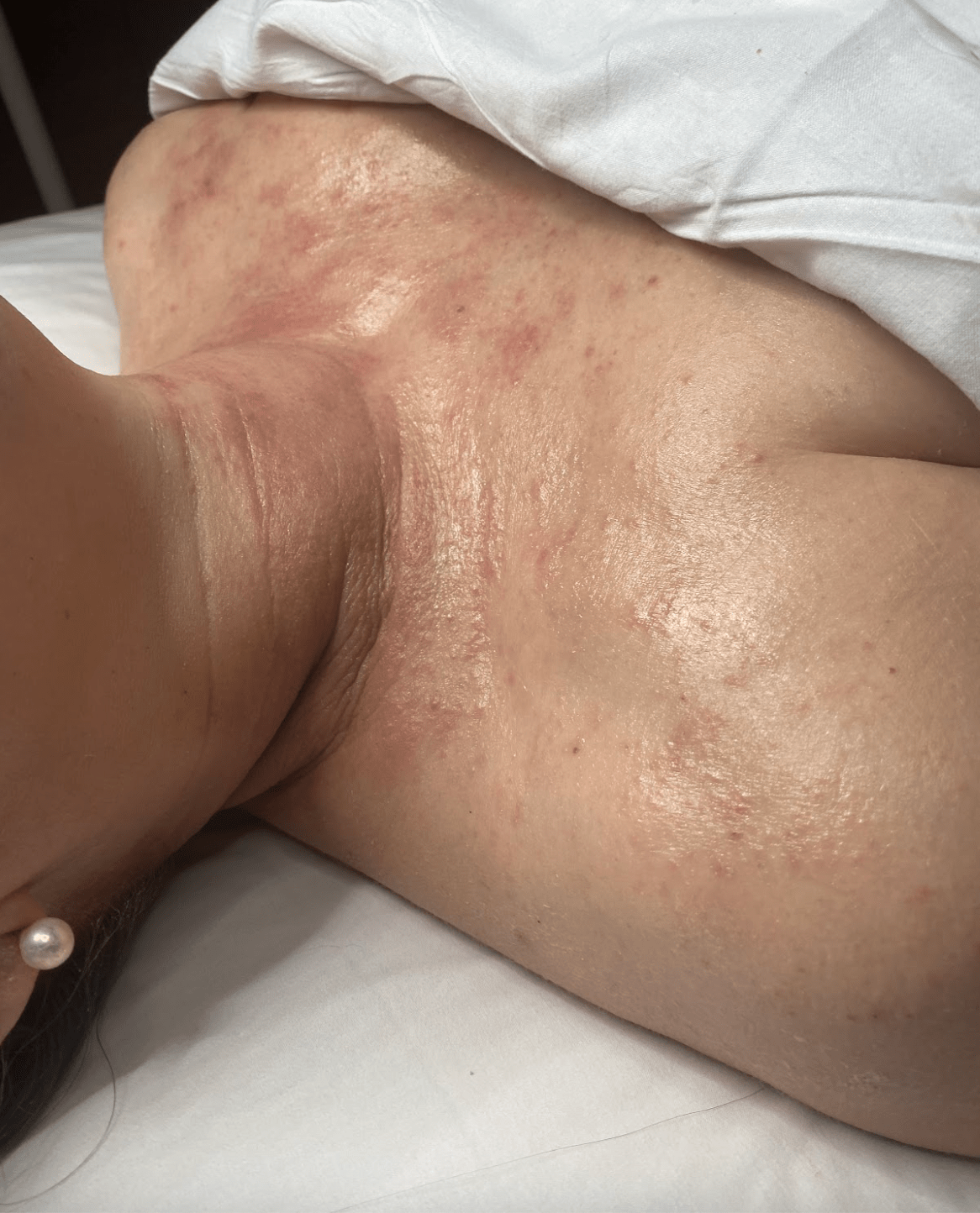 blog-acute-flare-of-chronic-atopic-dermatitis-2-skin-studio-arizona-noelani-ganz.png