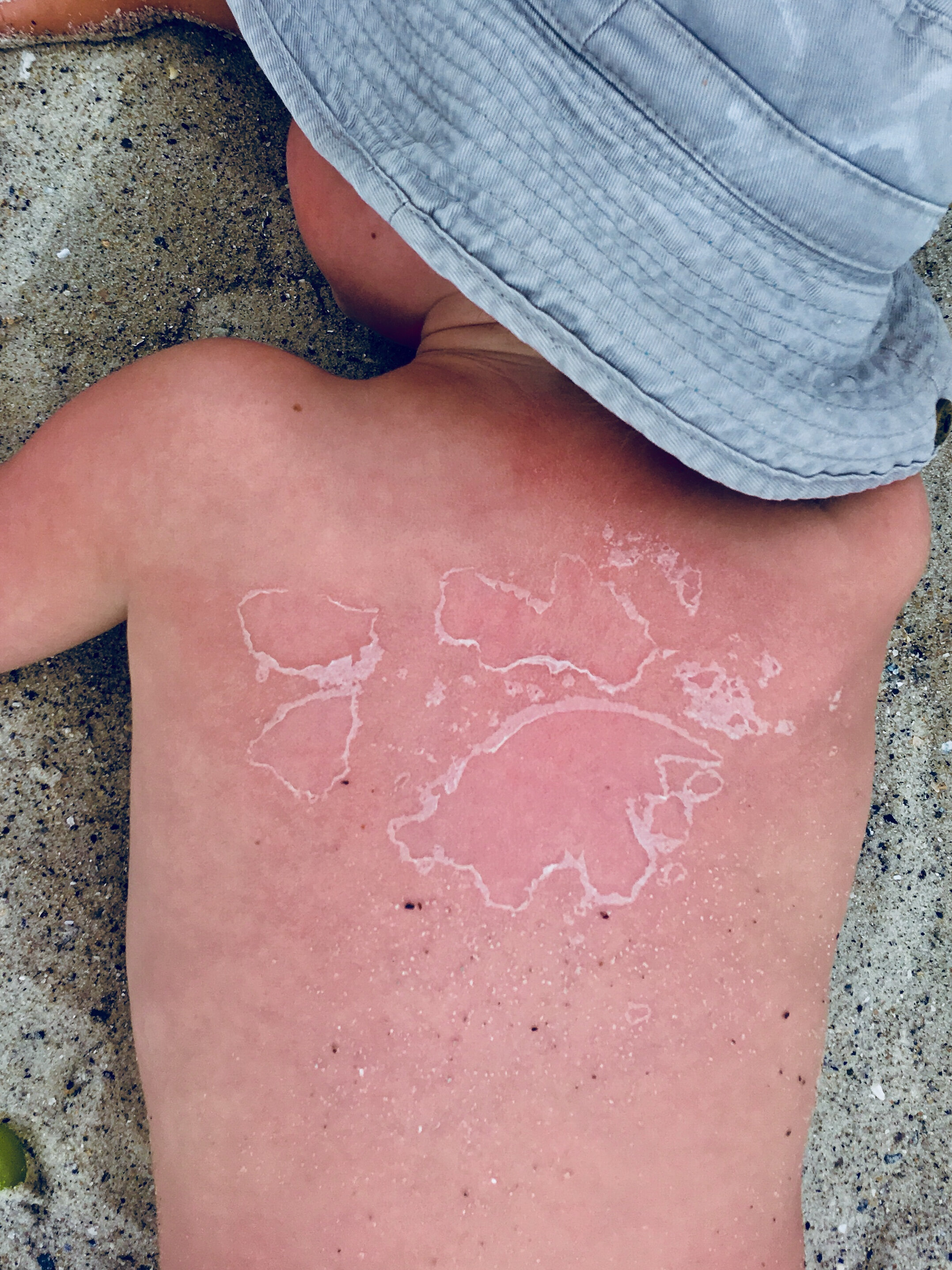 Sunburnt Youngsters In Hospital ‘disturbing — Dermatology Hawkes Bay
