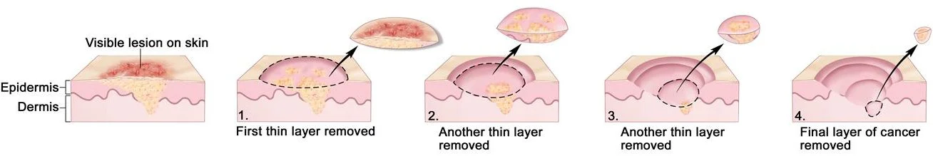 Sequential diagram illustrating removal of skin layers to eliminate skin cancer. It shows a visible skin lesion on the surface, with four steps: first, removing the top thin layer; second, removing another thin layer; third, removing an additional thin layer; and fourth, removing the final layer of cancer, revealing no remaining cancer cells.