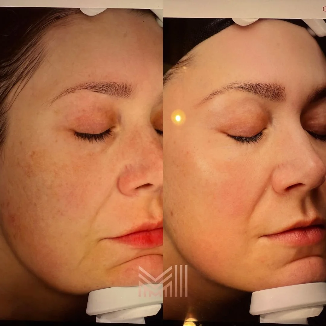 Before and after results of Fraxel laser resurfacing showing improved skin tone, smoother texture, and reduced sun damage