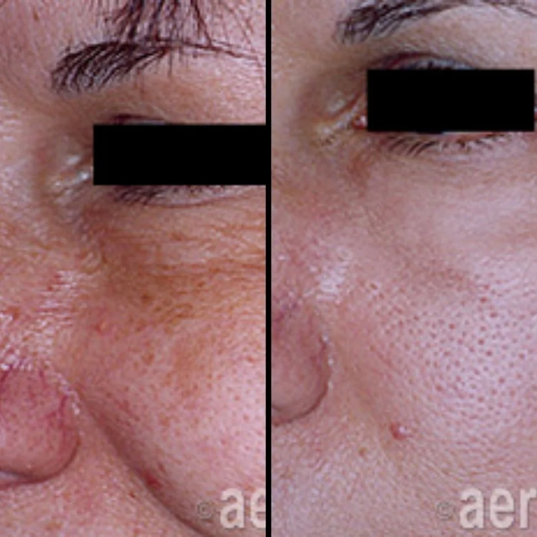 Comparison of a person's skin before and after skincare treatment, showing improved skin texture on the right side with less redness and smoother appearance.