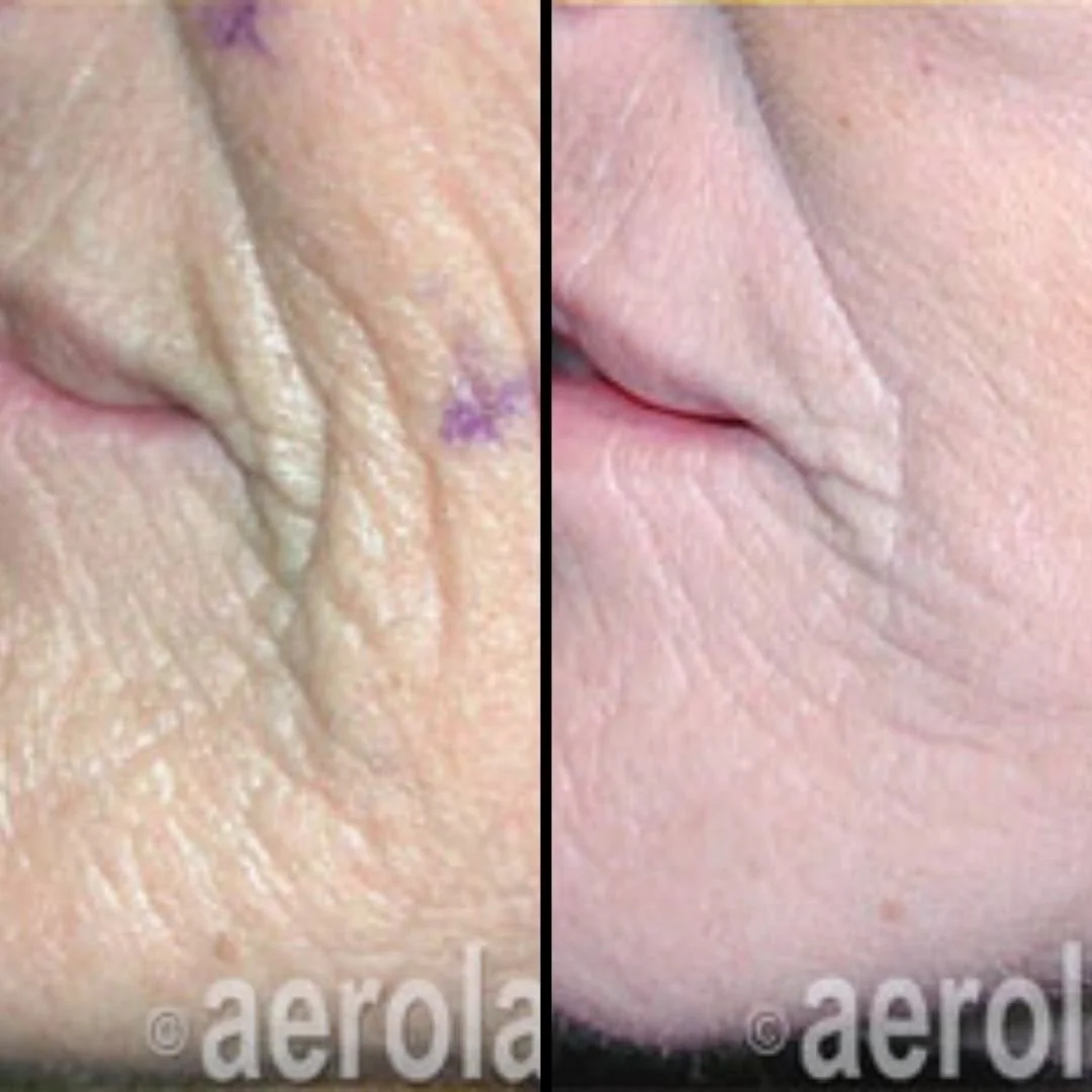 Comparison of skin close-up, showing reduction of wrinkles around the mouth on the right side.