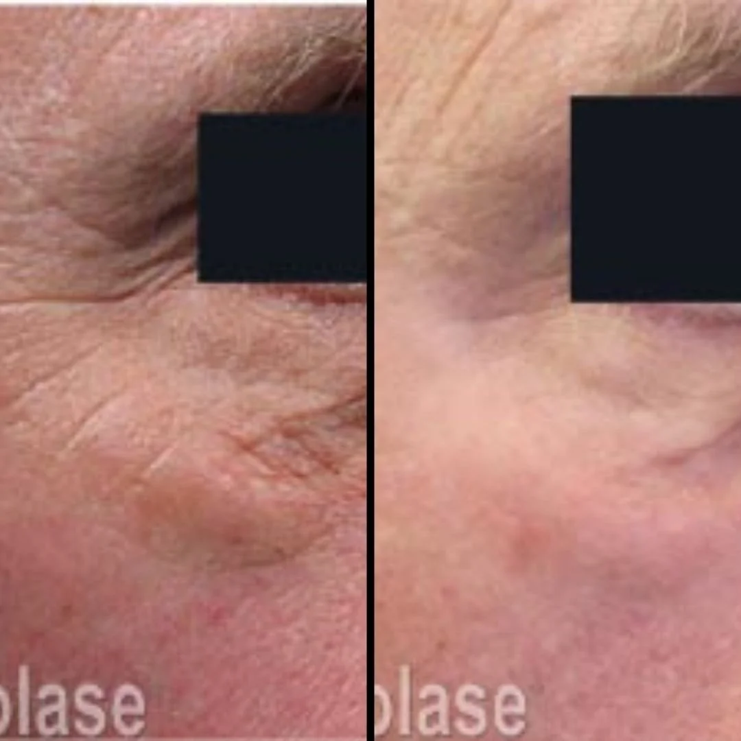 Close-up comparison of skin around the eye showing improvements in skin texture and wrinkles.
