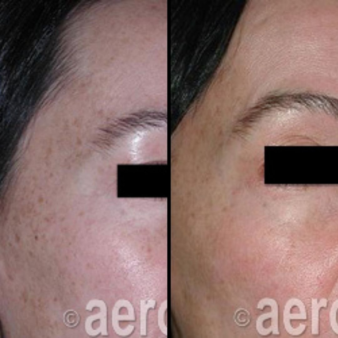 Side-by-side comparison of a person's face showing skin before and after treatment, with the left image displaying more blemishes and redness, and the right image showing clearer, smoother skin.