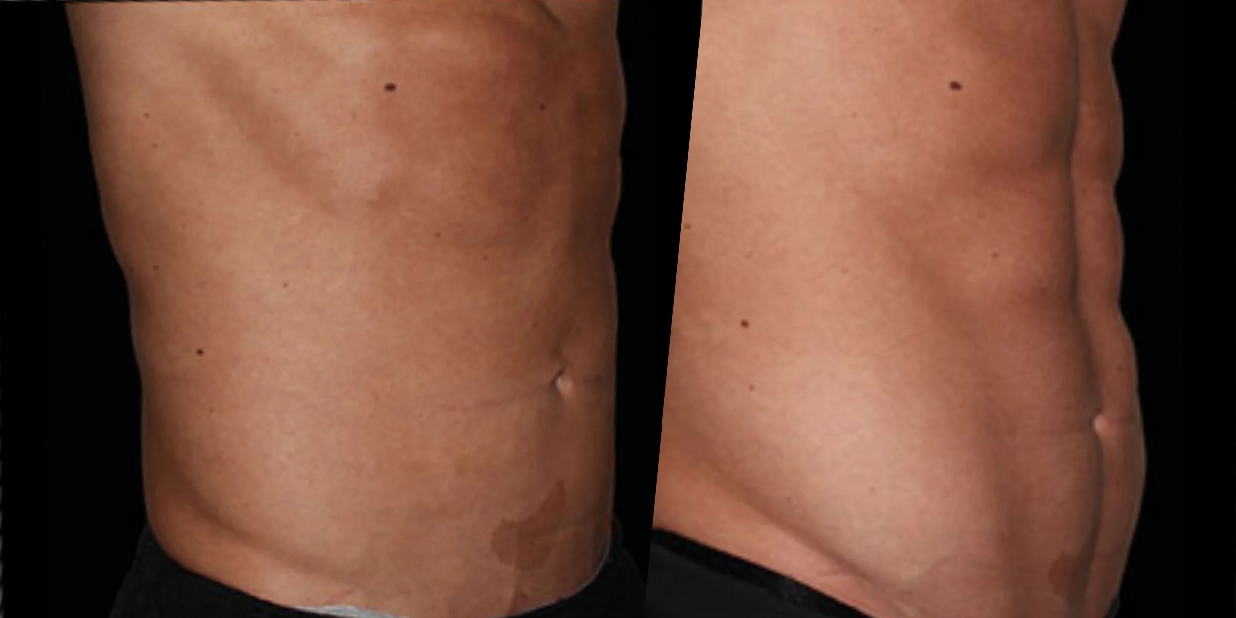 Side-by-side comparison of a person's midsection showing a before-and-after transformation, highlighting a reduction in abdominal fat and a more toned appearance.