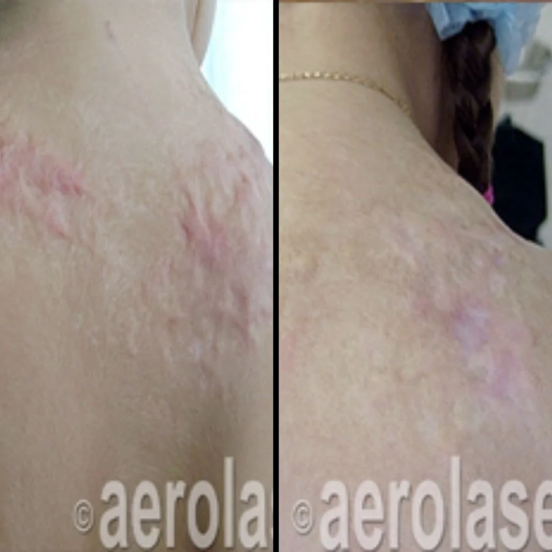 Comparison of a person's shoulder showing skin irritation or stretch marks before and after treatment. The left side depicts more pronounced irritation, while the right side shows improvement.