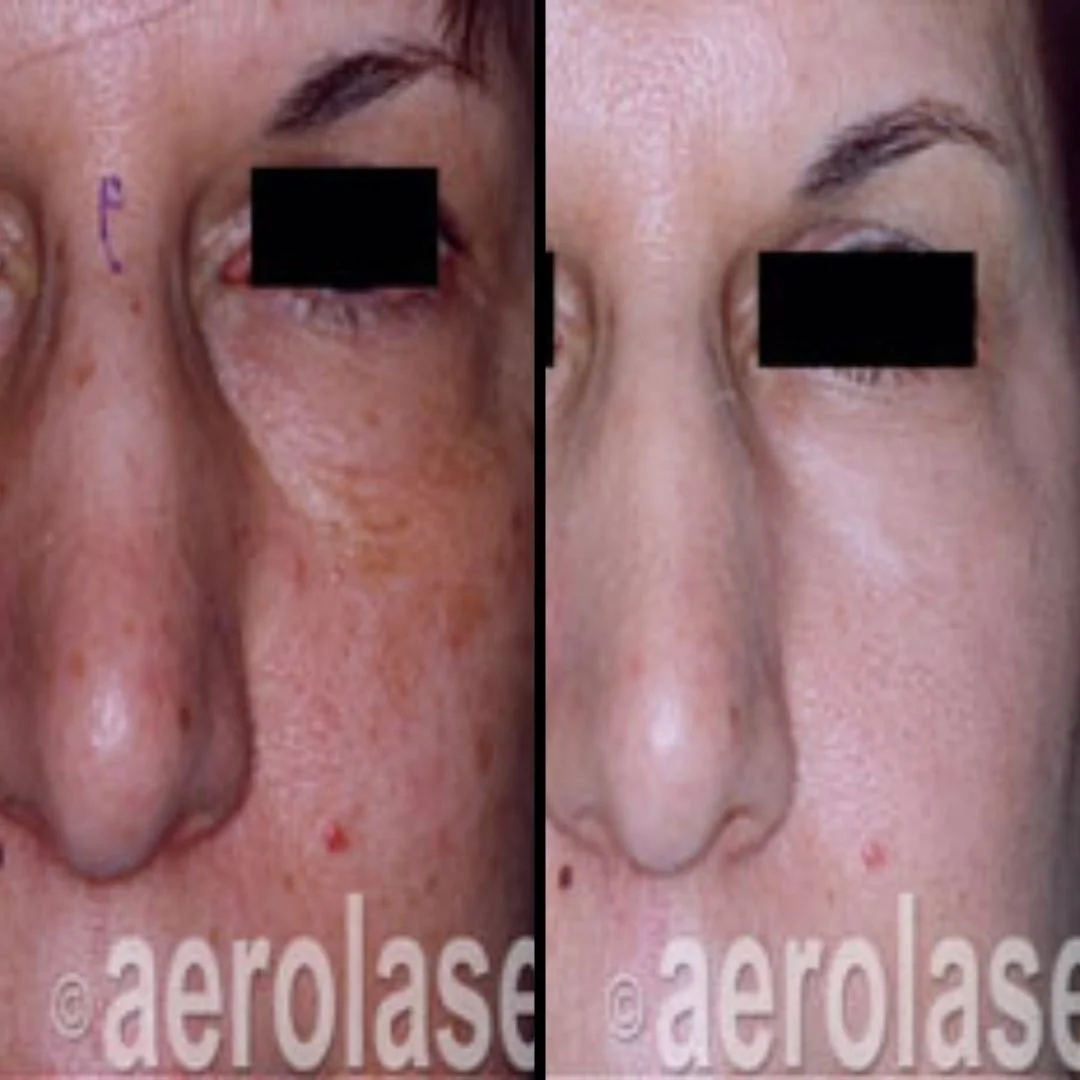 Side-by-side comparison of a woman's face showing skin improvement on the left and clear skin on the right after treatment.