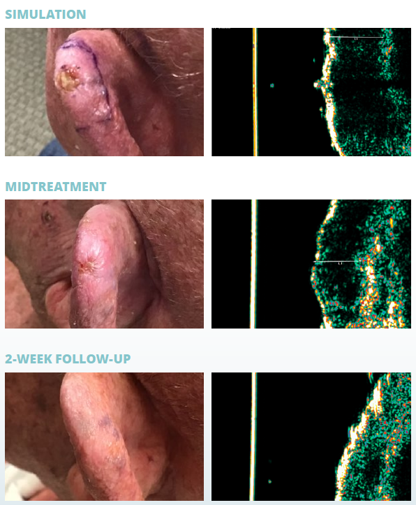Progress photos of a skin condition on a person's ear taken at different stages: initial, mid-treatment, and 2-week follow-up, showing healing and reduction of inflammation.