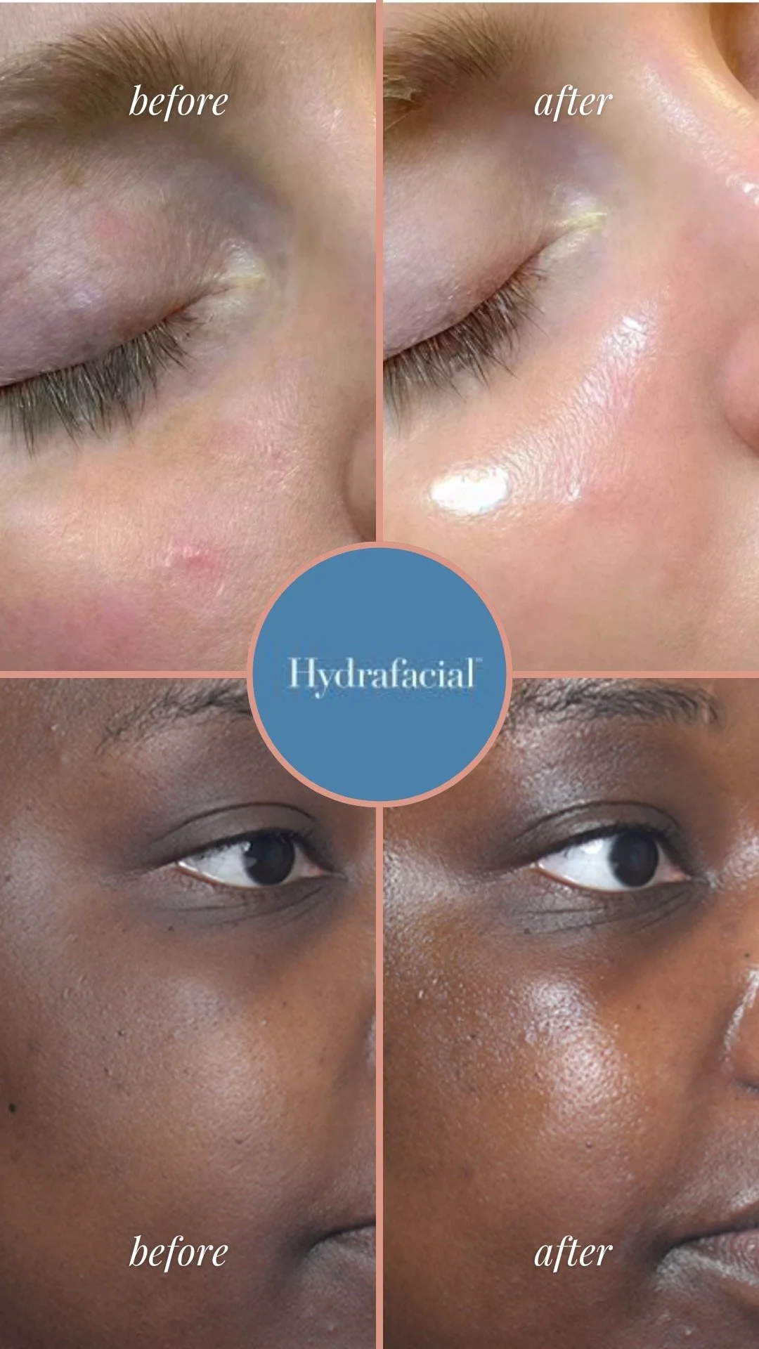 Deluxe HydraFacial before and after showing smoother, hydrated and more radiant-looking skin