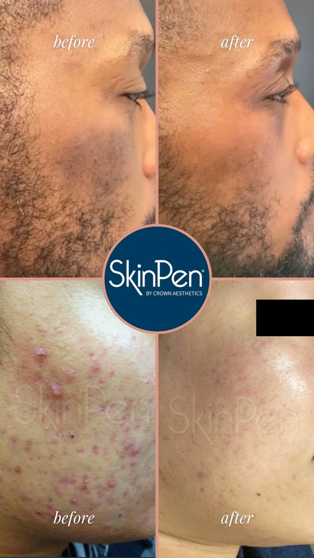 SkinPen Microneedling before and after showing improvement in acne scarring and skin texture