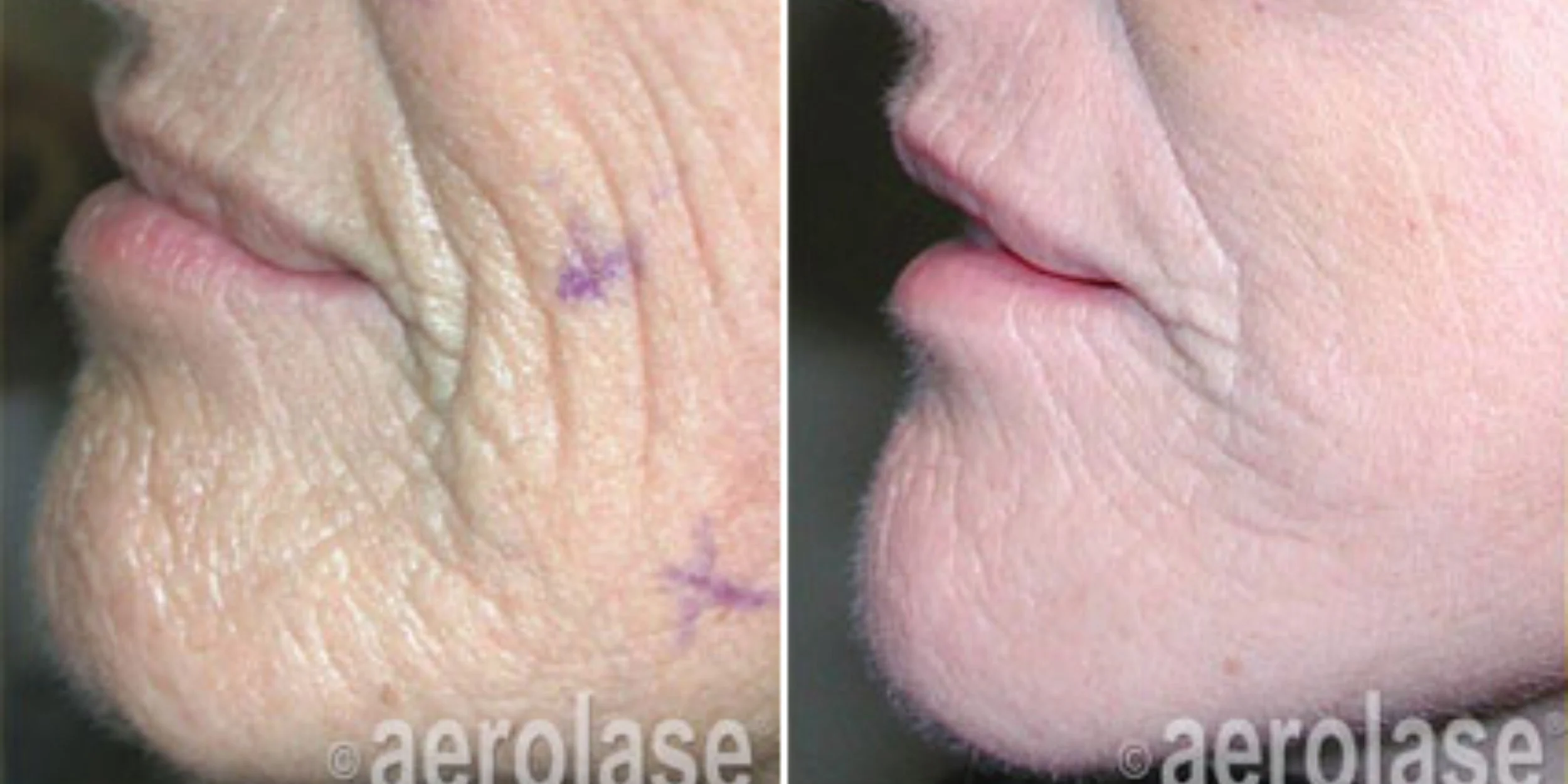 Close-up side-by-side comparison of skin around the mouth, showing wrinkles and improvement after treatment. The left side shows more wrinkles with purple markings, and the right side shows smoother skin.
