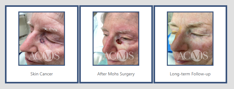 Series of three photos showing a person with skin cancer on the nose, postoperative healing after Mohs surgery, and a long-term follow-up.