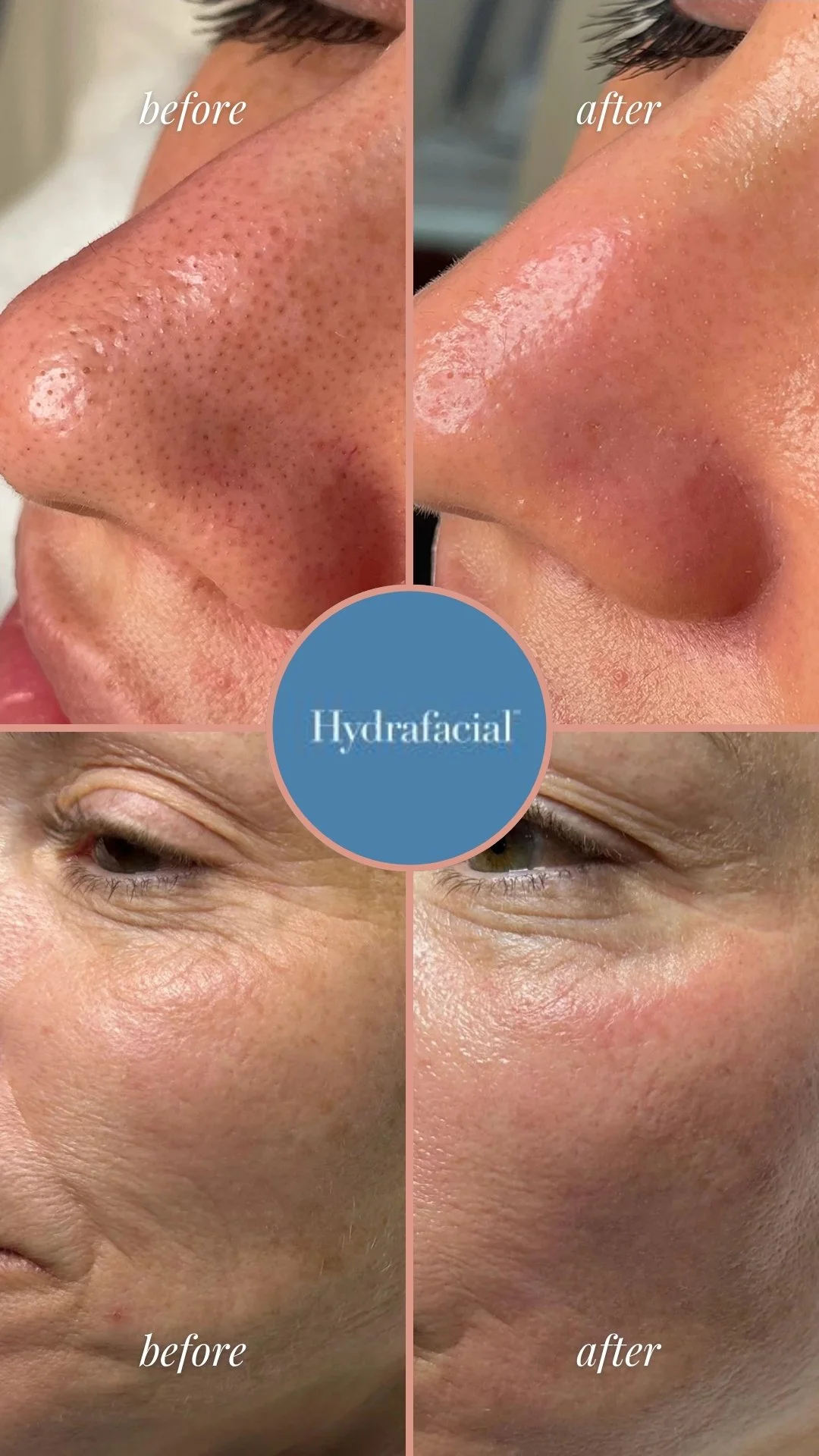 Signature HydraFacial before and after showing smoother, hydrated and more radiant-looking skin