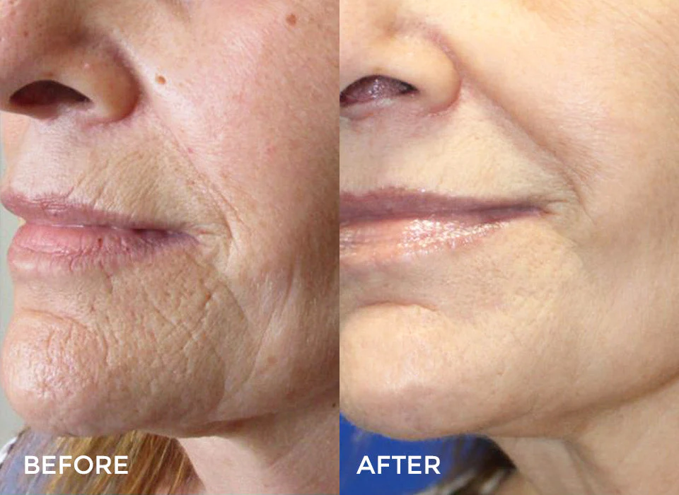 Comparison of a person's face showing skin improvement, with the left side labeled 'BEFORE' and skin appearing dry and wrinkled, and the right side labeled 'AFTER' with smoother, clearer skin.