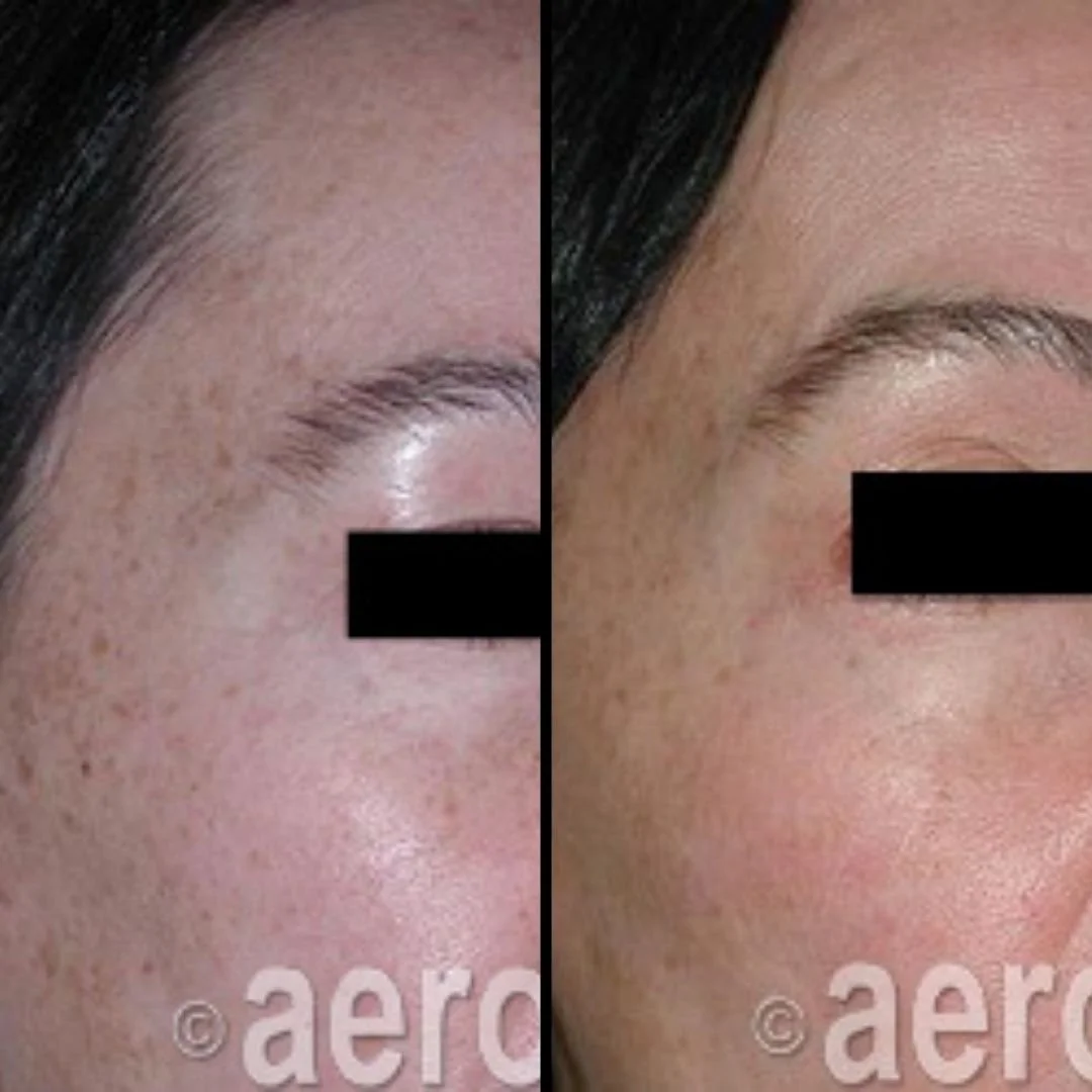 Side-by-side comparison of a woman's cheek and eye area, showing improvement in skin texture, fine lines, and pigmentation in the after photo.
