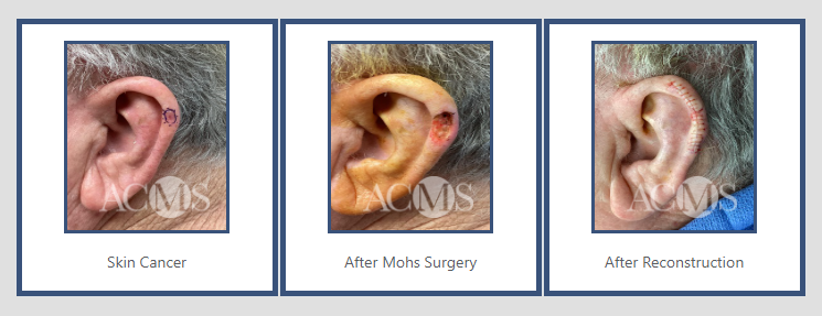 Comparison of three ears: one with skin cancer, one after Mohs surgery, and one after reconstruction.