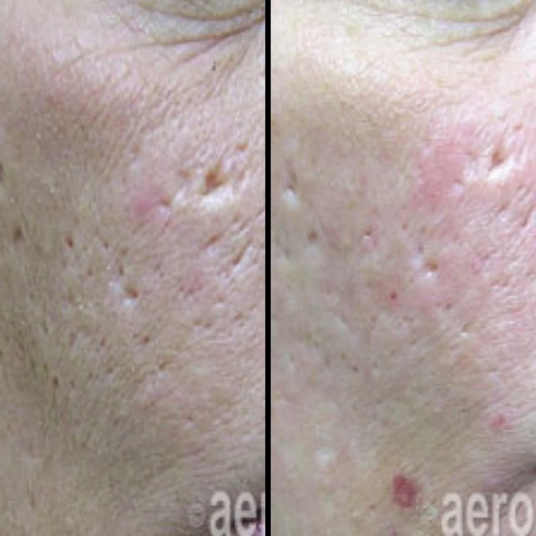 Close-up comparison of skin with scars and acne before and after treatment, showing reduced redness and scarring on the right side.