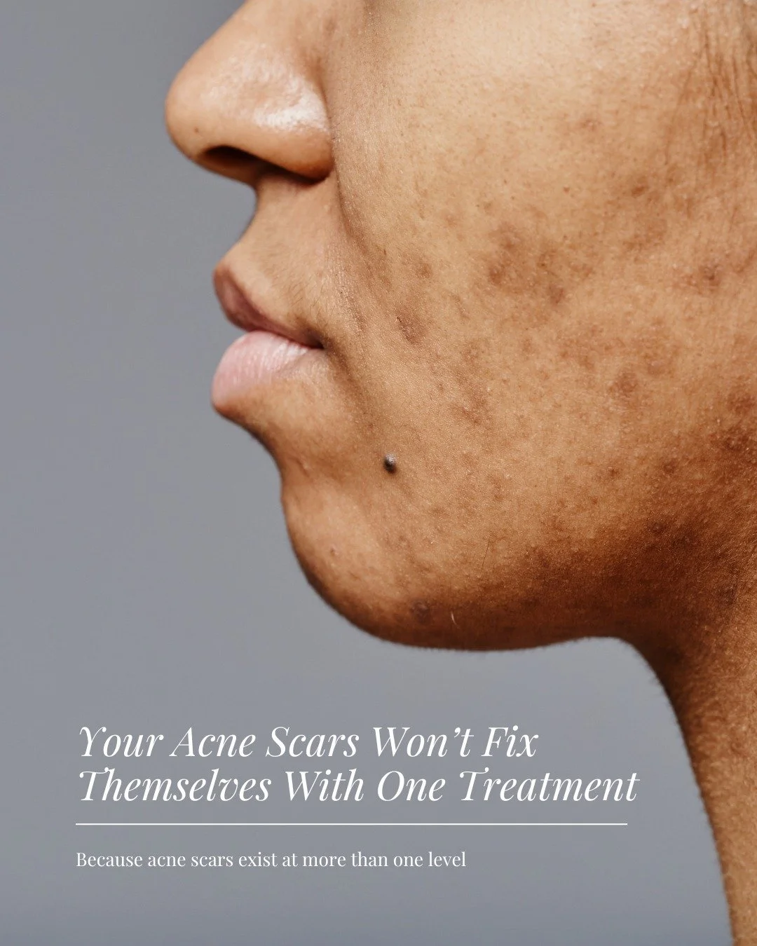 Des cicatrices d&rsquo;acn&eacute;? Tu es au bon endroit.

Cr&eacute;ons un protocole personnalis&eacute; qui fonctionne vraiment pour ta peau.

Acne scarring? You&rsquo;re in the right place.

Let&rsquo;s create a personalized protocol that actually