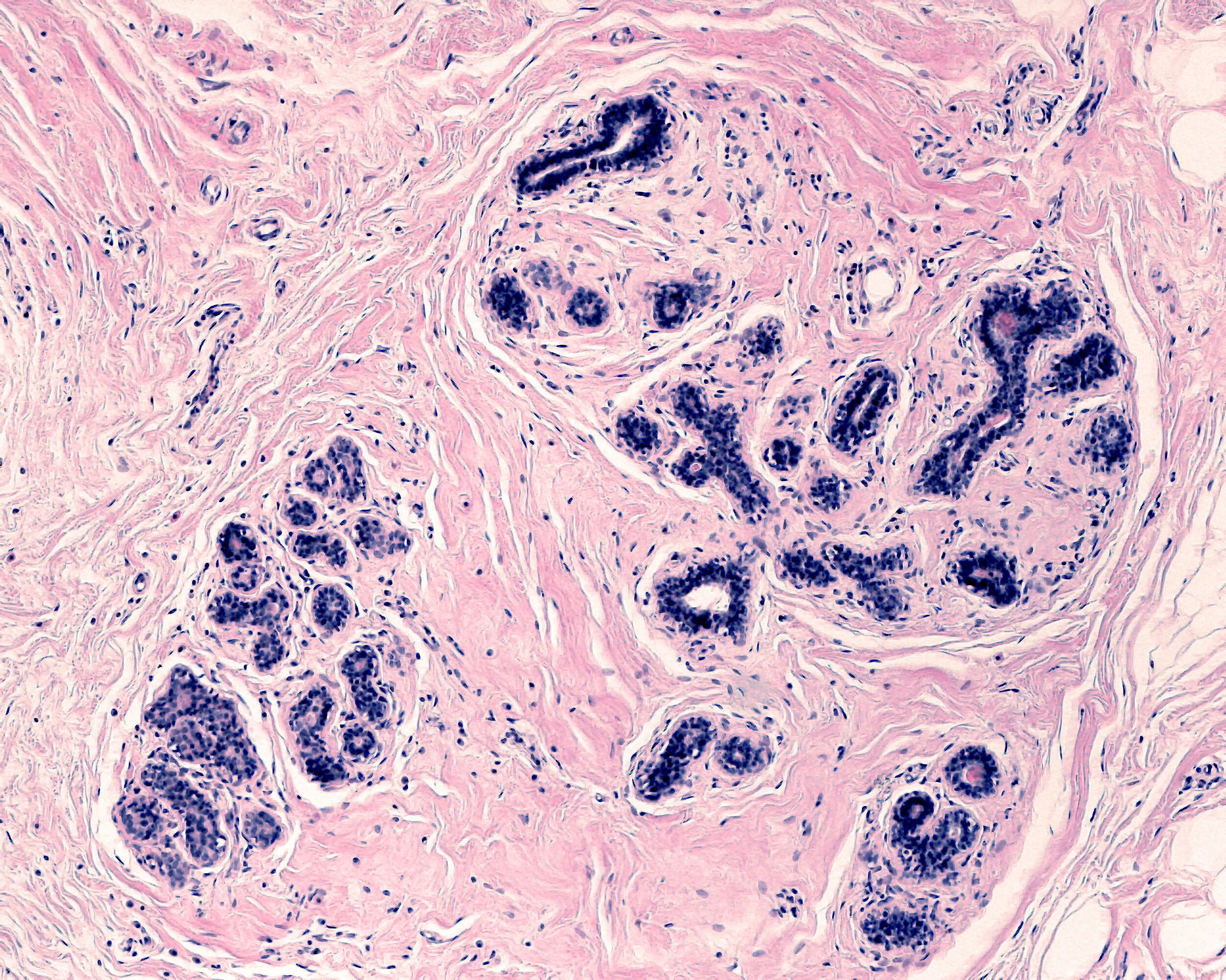 Treatment of Genital Swelling and Fibrosis