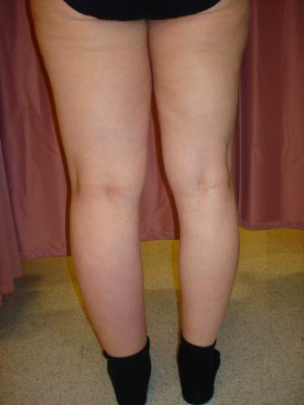 Karen Ashforth LE&RN: Identifying Fibrosis in Every Stage of Lymphedema — Karen Ashforth