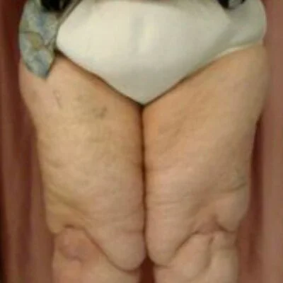 LE&RN: Understanding Fibrosis in Lipedema