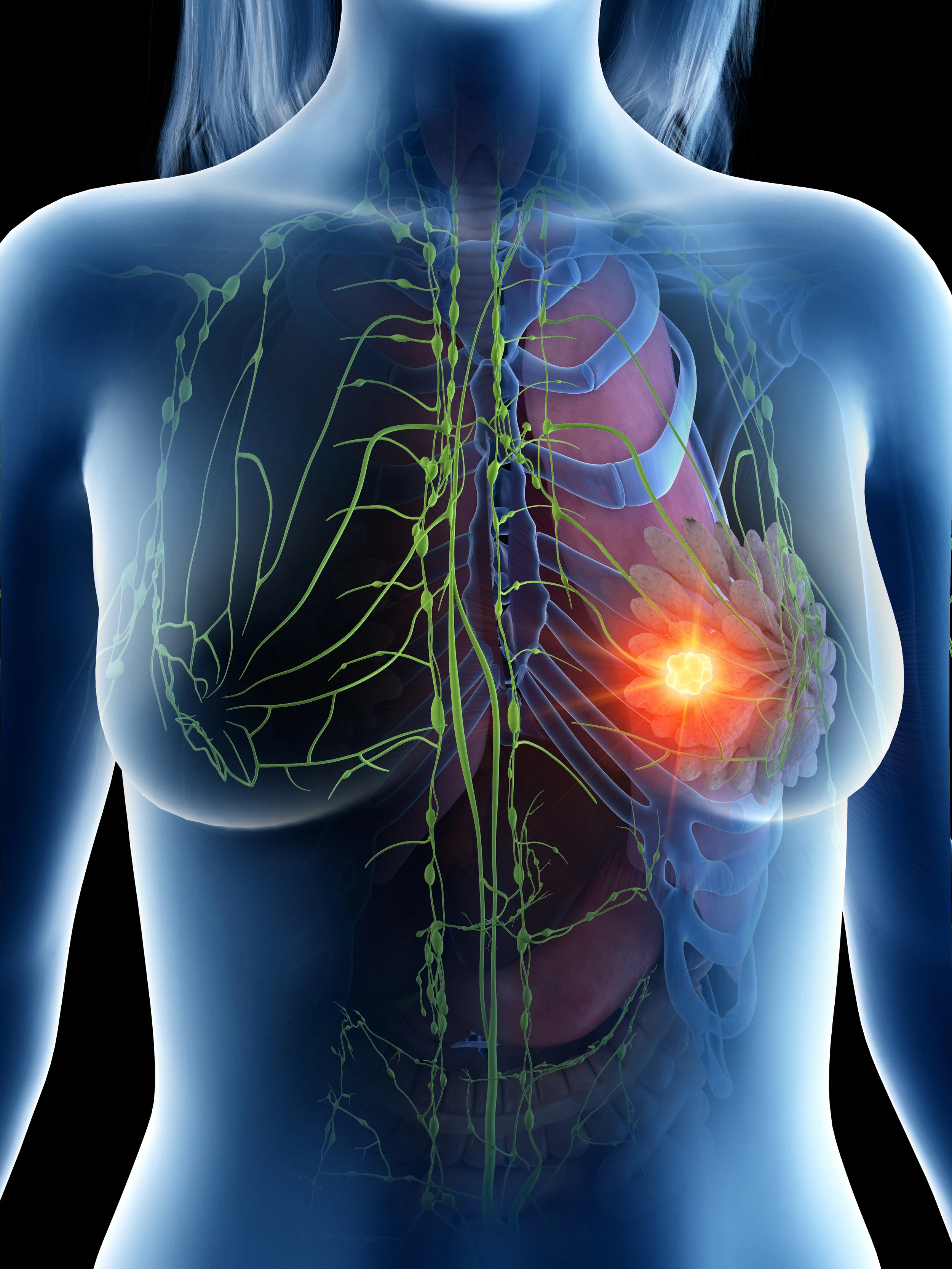 Karen Ashforth Journal of Lymphoedema: A New Treatment for Soft-Tissue Fibrosis in the ...