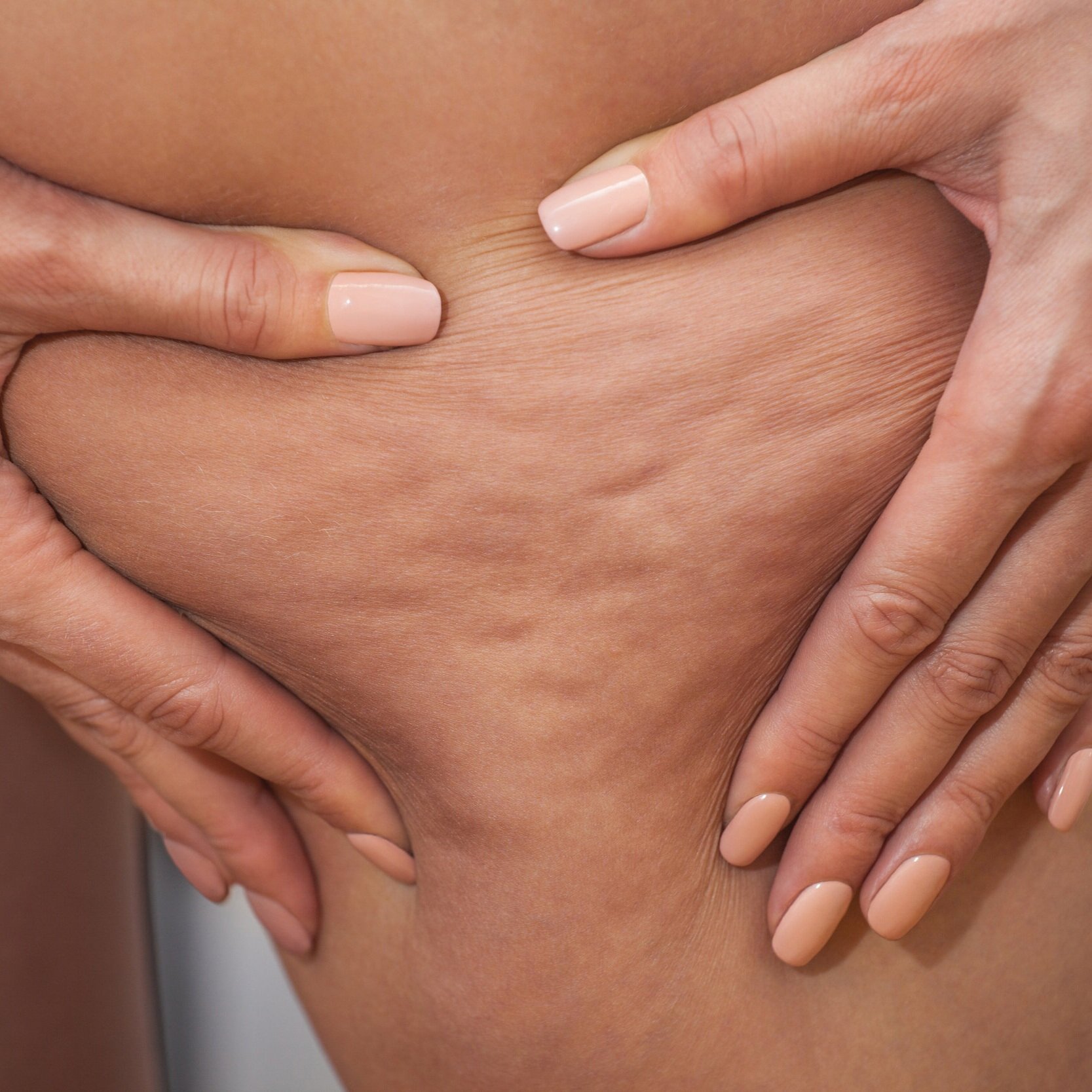 Treating Lipedema-Related Fibrosis