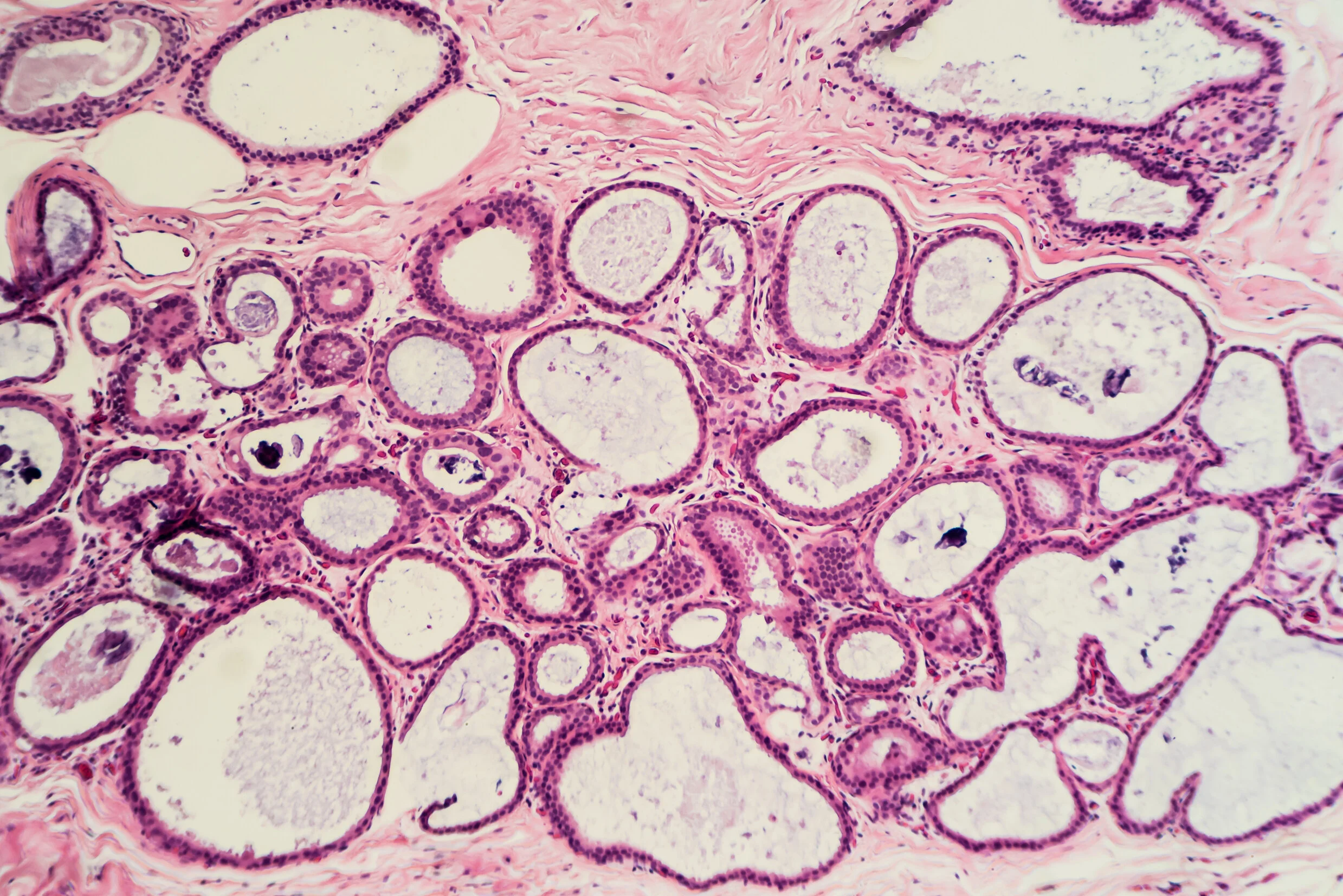 Treating Breast Fibrosis