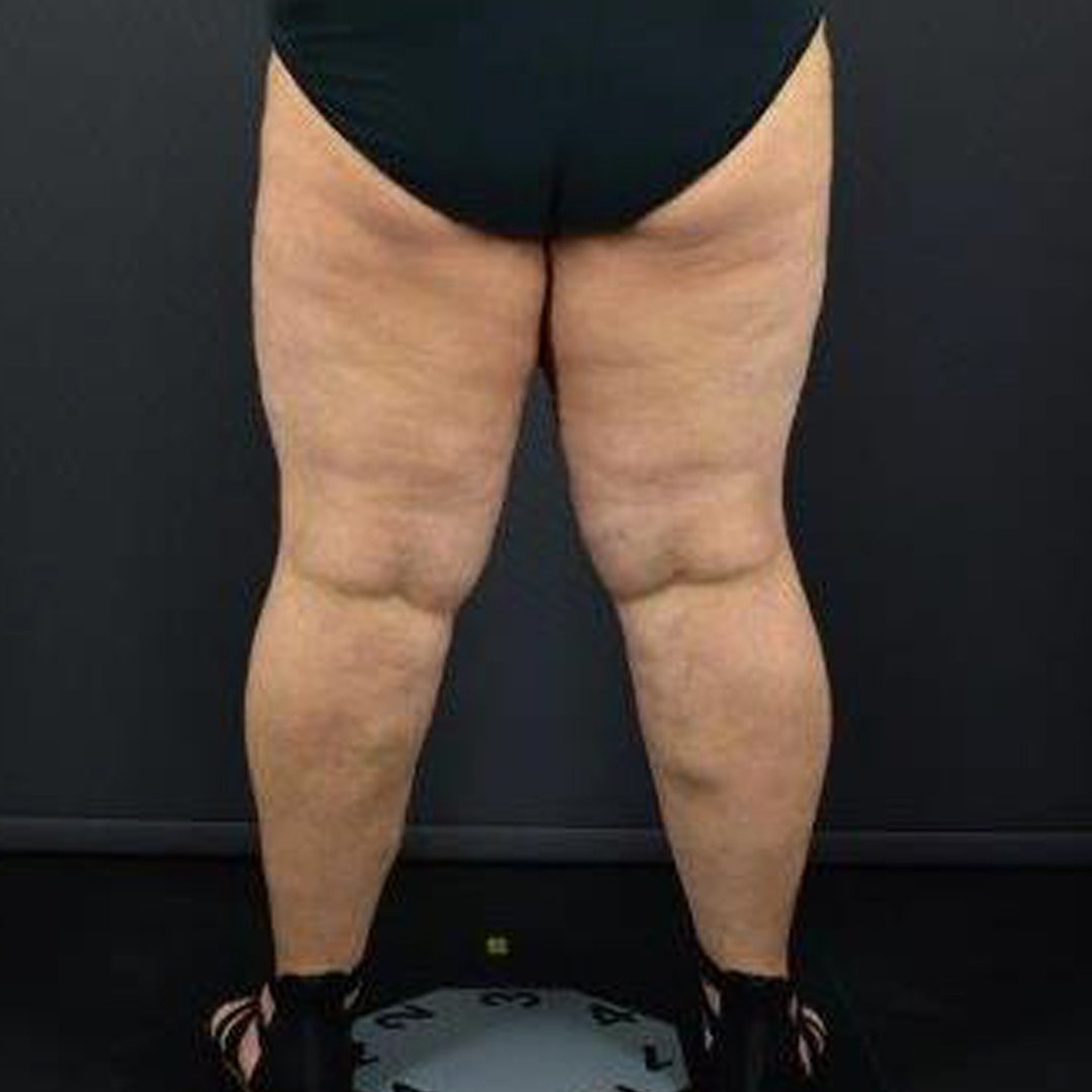 Understanding Lymphedema in Lipedema