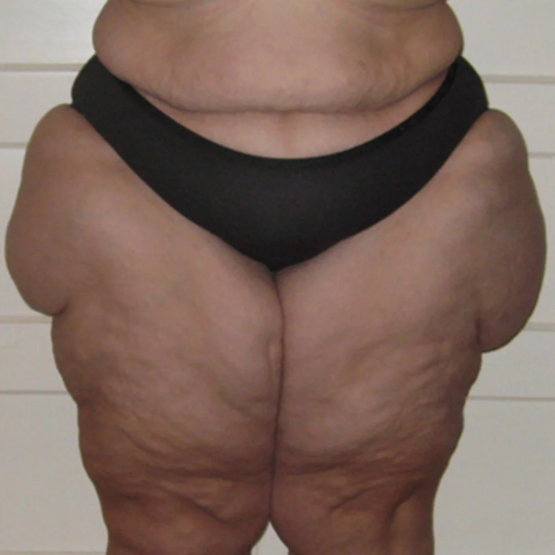 Understanding Lipedema and Lymphedema  Fibrosis 