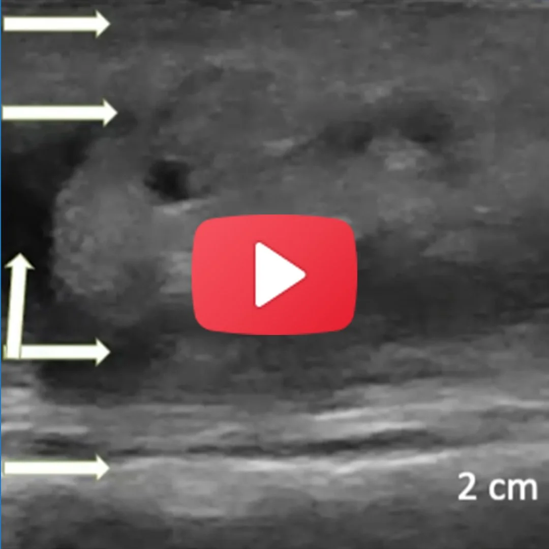 Identifying and Treating Lipedema-Related Fibrosis