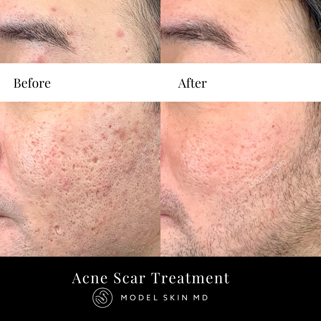 Acne Scar Treatment Vancouver's Aesthetic Cosmetic Laser Clinic