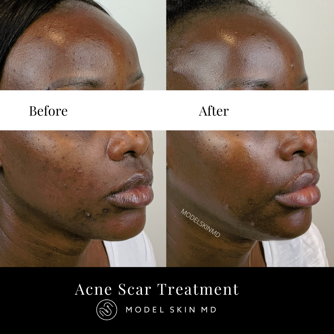 Acne Scar Treatment Vancouver's Aesthetic Cosmetic Laser Clinic