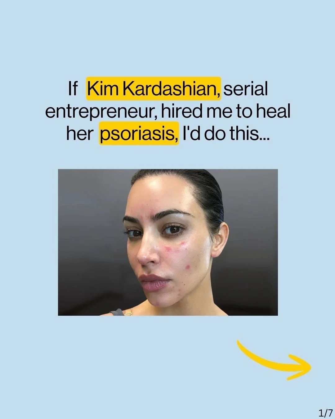 If Kim Kardashian hired me to heal her psoriasis, here&rsquo;s exactly what I&rsquo;d do.

Spoiler: It has nothing to do with another cream, supplement protocol, or &ldquo;managing&rdquo; symptoms.

Psoriasis isn&rsquo;t only a skin problem.

It&rsqu