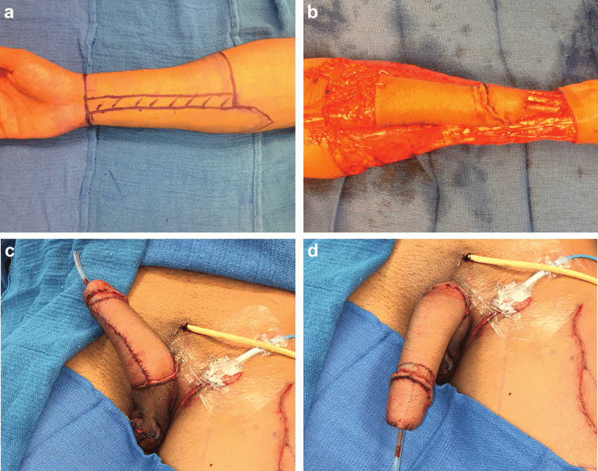 Radial-forearm-free-flap-phalloplasty-design-and-outcomes-a-preoperative-flap-markings.png