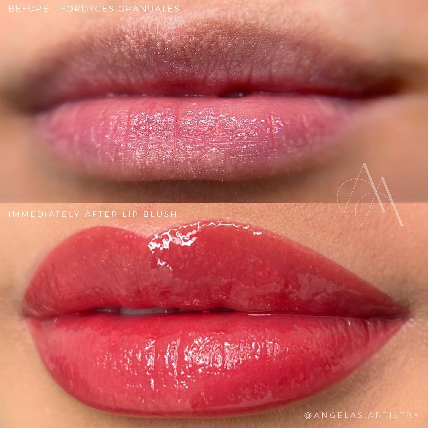 Lip blush on Fordyces Granules

Fordyces granules are white sebaceous glands on your lips. It can make you lose colour and definition in your lips. Lip blush can bring back the colour and definition 💯

__________________________________________

𝘼?
