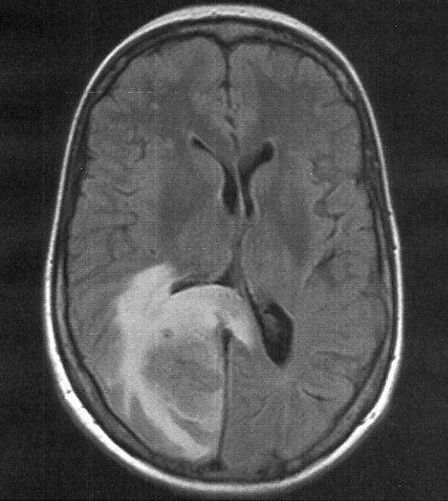 MRI section showing a metastasis at the back of the brain with extensive swelling around it.