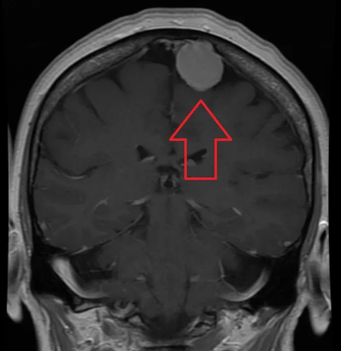 Front-view MRI section showing a round, brightly enhancing tumour at the top against the skull, marked with a red arrow.