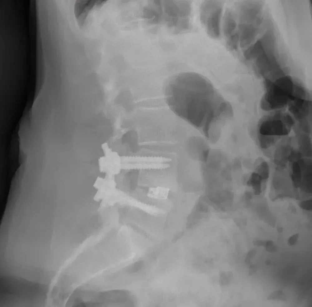Radiographie de profil du bas du dos avec des vis pédiculaires, des tiges et une cage intersomatique.