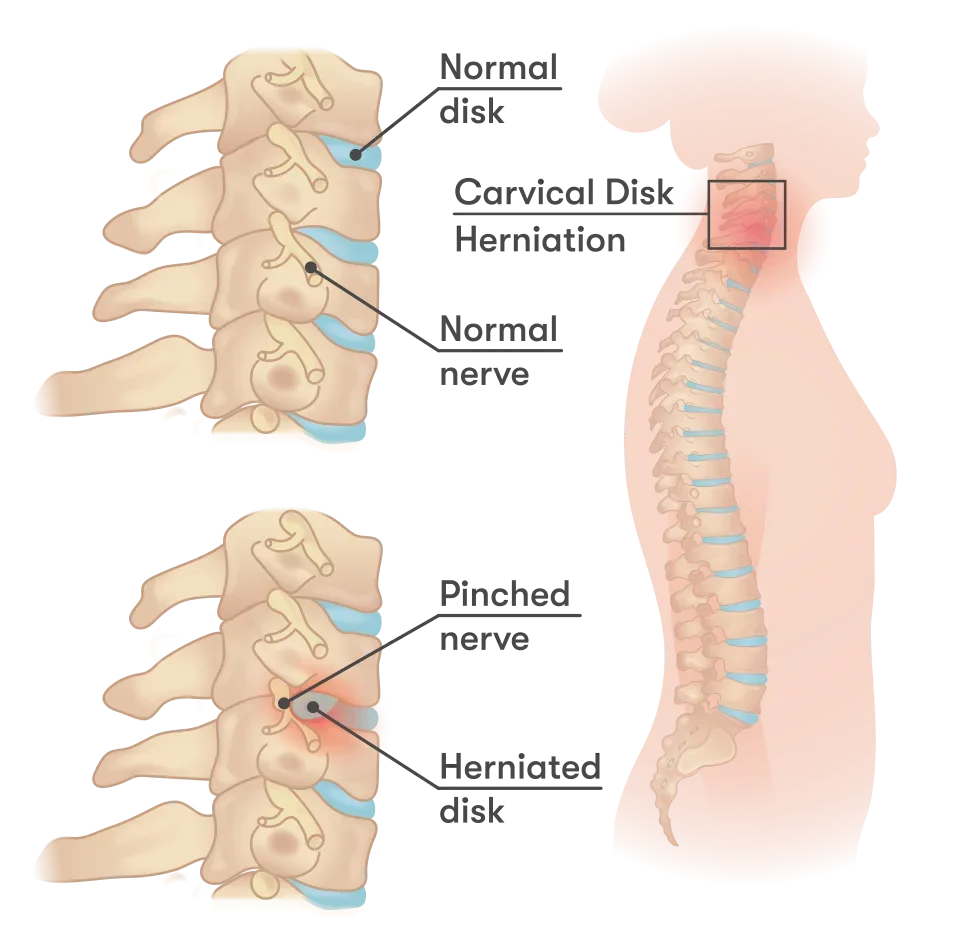 Drawing of the cervical spine: at the top a healthy disc and nerve, at the bottom a bulging disc pressing on the nerve.