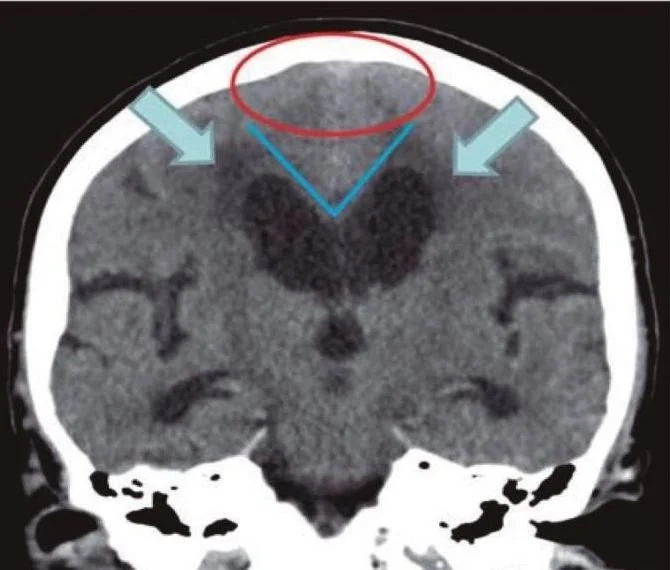 Front-view brain scan showing enlarged ventricles and coloured markings of the angle between the lateral ventricles.