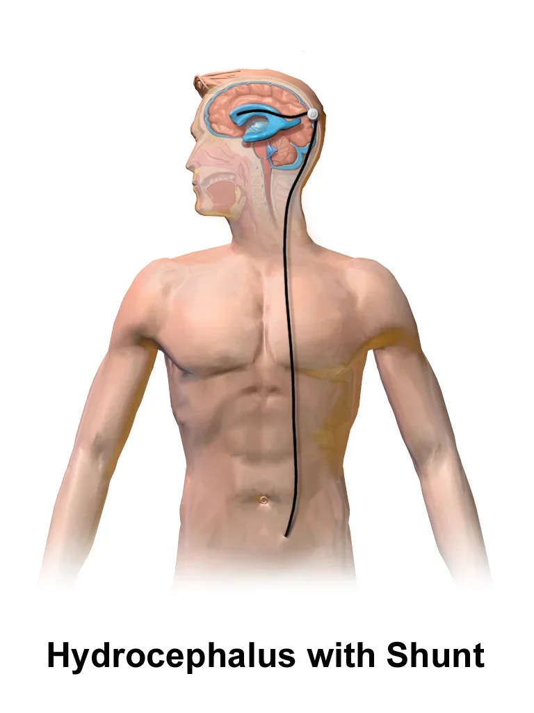 Illustration of an adult with a shunt running from a brain ventricle under the skin to the abdomen.