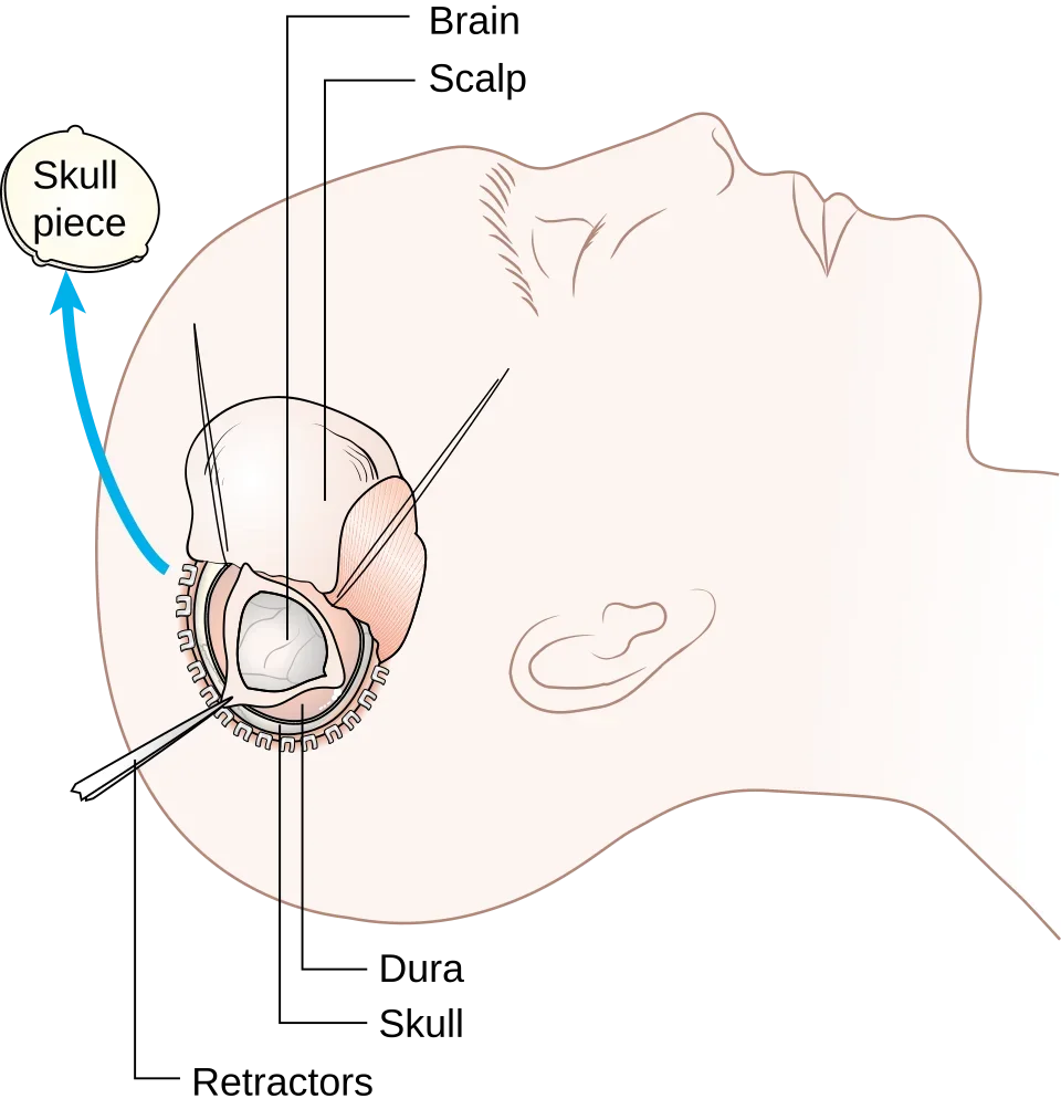 Drawing of a head with an opened skull; the removed piece of bone lies next to it.